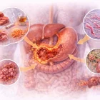 Рак на стомаха Stomach cancer